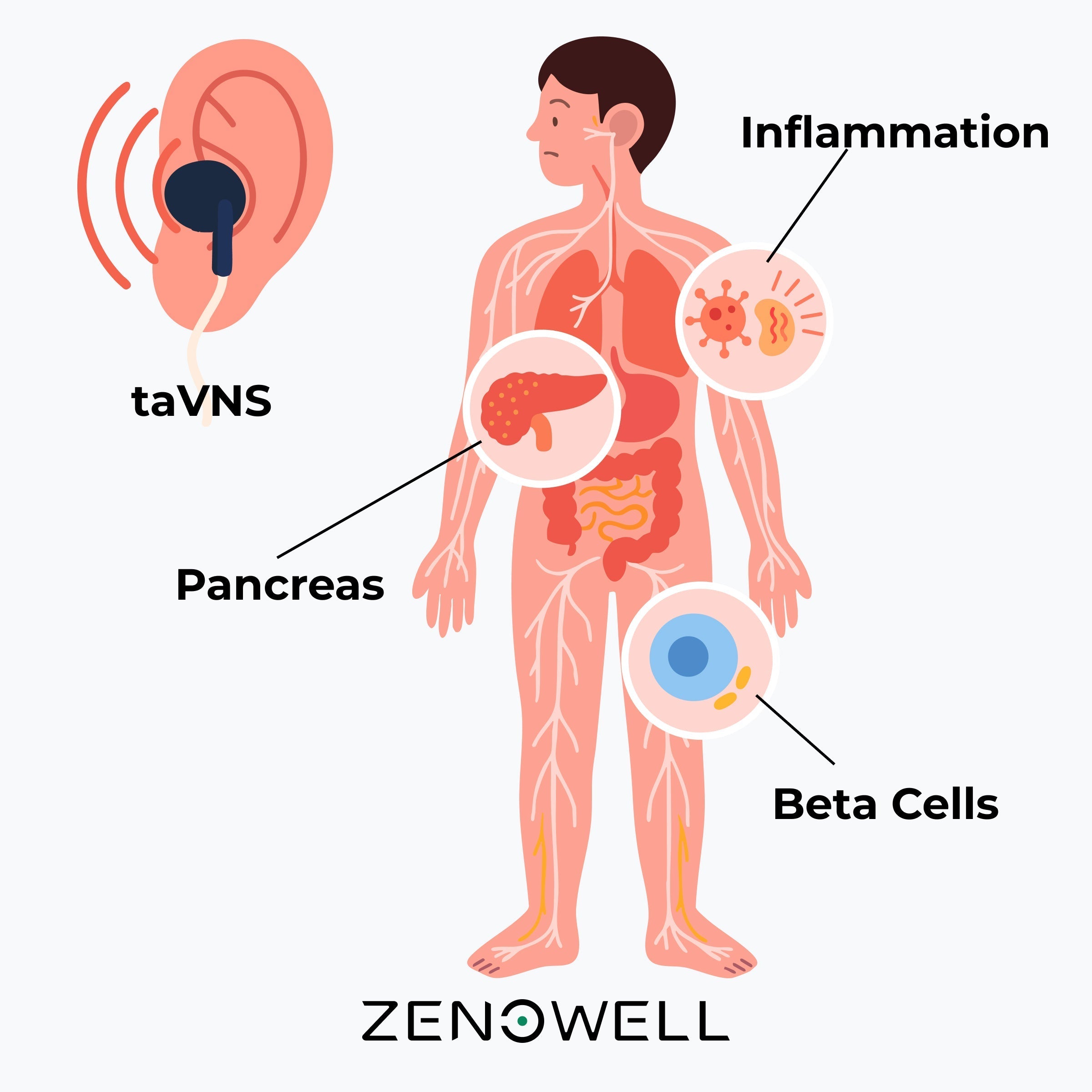 Can taVNS Help Improve Type 2 Diabetes or Its Complications?